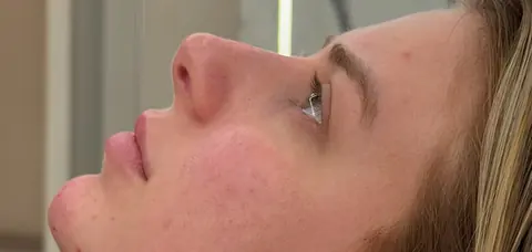 Perfil de paciente depois do tratamento, com queixo e mandíbula definidos