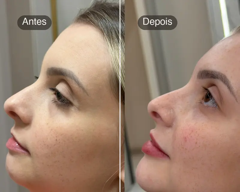 Antes e depois de uma harmonização full face, de perfil