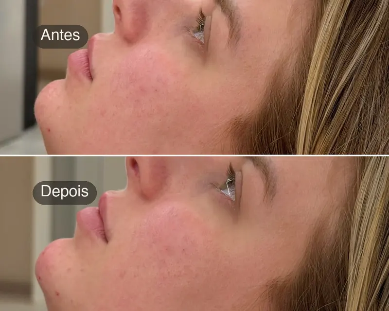 Antes e depois do perfil, da boca ao pescoço